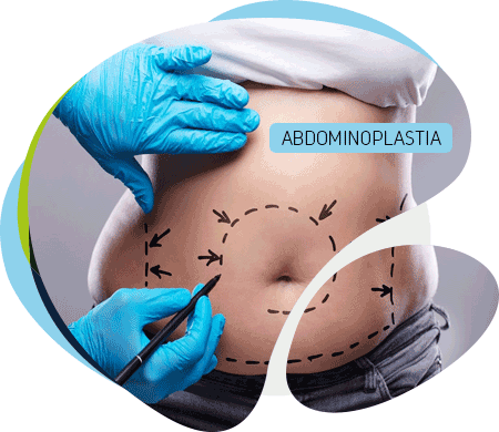 Abdominoplastia-quito Abdominoplastia quito