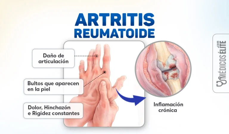 Artritis Reumatoide (Inflamación Crónica) Artritis Reumatoide (Inflamación Crónica)