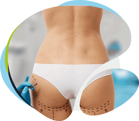 Aumento-levantamiento-gluteos-estrias Aumento levantamiento gluteos estrias