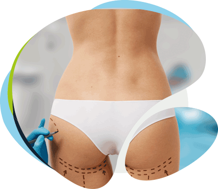 aumento-levantamiento-gluteos-estrias