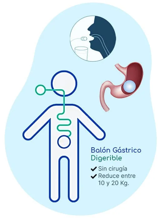 balon-gastrico-digerible-quito