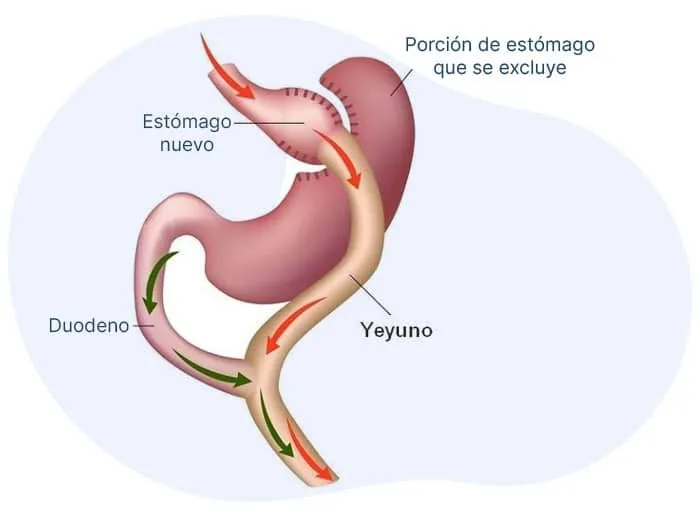 bypass-gastrico