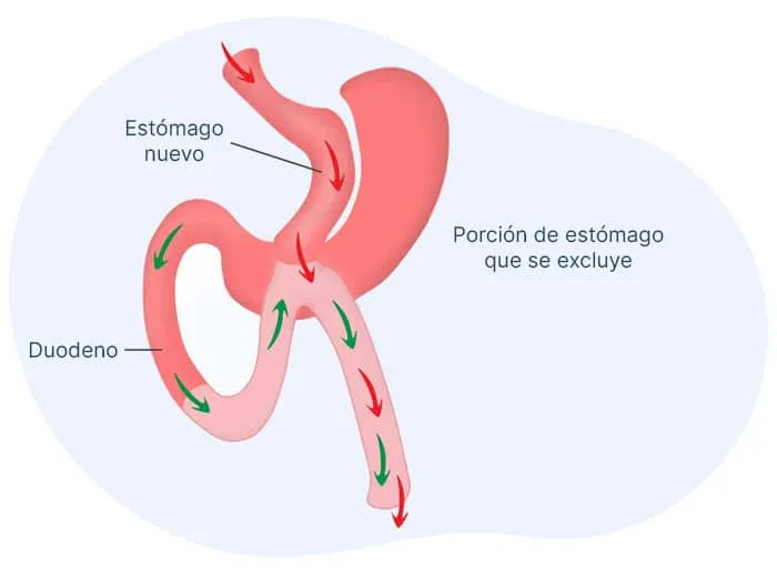 bypass-una-sola-anastomosis