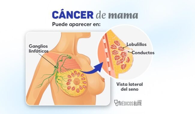 Lugares en donde puede aparecer el Cáncer de Mama