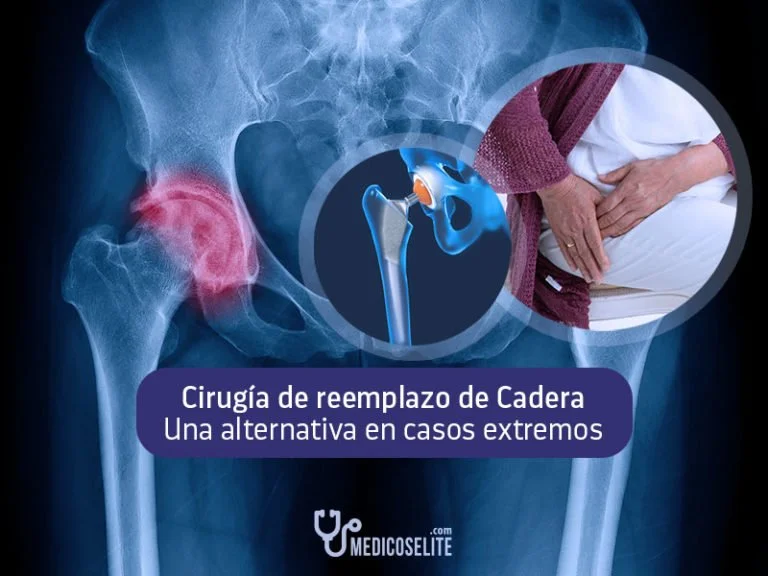 Cirugía de Reemplazo de Cadera Cirugía de Reemplazo de Cadera