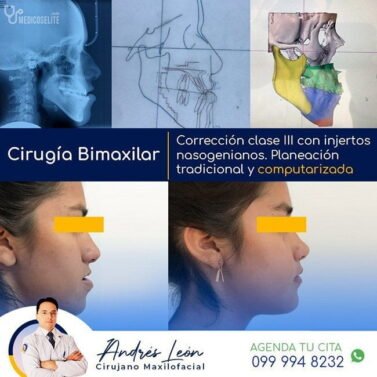 cirugia-maxilar