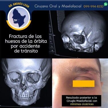 cirugia-maxilofacial-minima-cicatriz