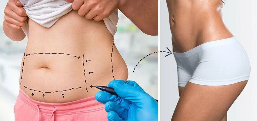 cirugia-plastica-liposuccion
