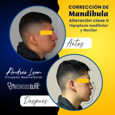 correccion-mandibula-maxilofacial
