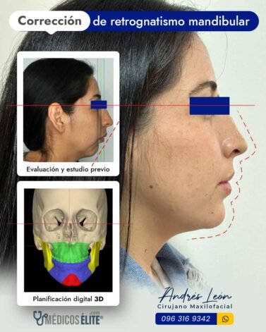 correccion-retrognatismo-mandibular-cirugia-maxilofacial