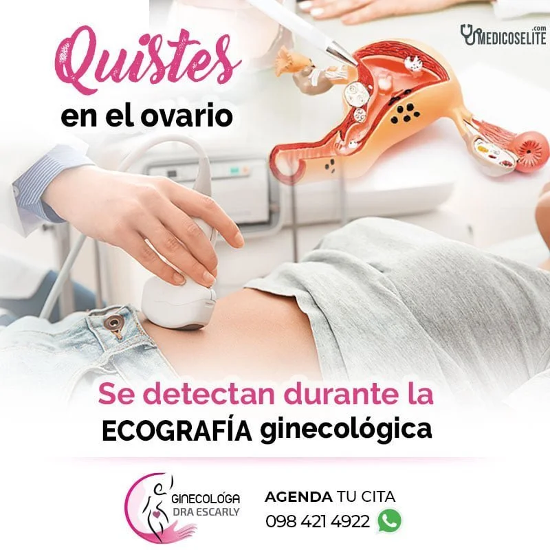 deteccion-quistes-ovario deteccion-quistes-ovario