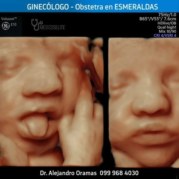 ecografia3d-esmeraldas-dr-oramas-ginecologo ecografia3d-esmeraldas-dr-oramas-ginecologo