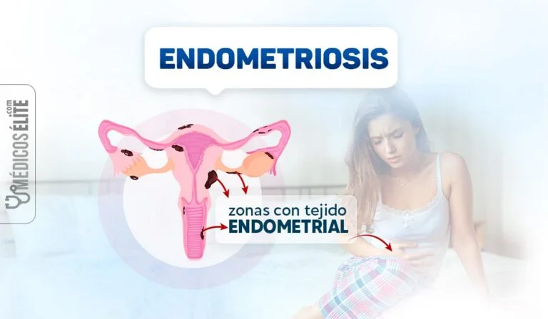 Endometriosis: síntomas, diagnóstico y tratamiento Endometriosis: síntomas, diagnóstico y tratamiento