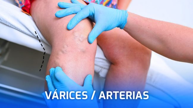 especialista-en-varices