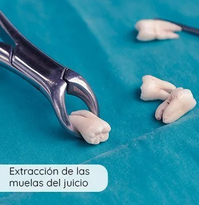 Extracción De Las Muelas Del Juicio En Quito Extracción De Las Muelas Del Juicio En Quito