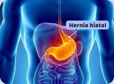 La Hernia Hiatal Se Puede Detectar Por Radiografía