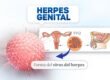 Herpes Genital