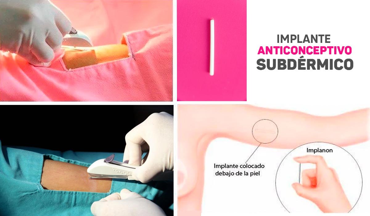 implante-anticonceptivo-subdermico-quito