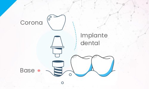 implante-dental