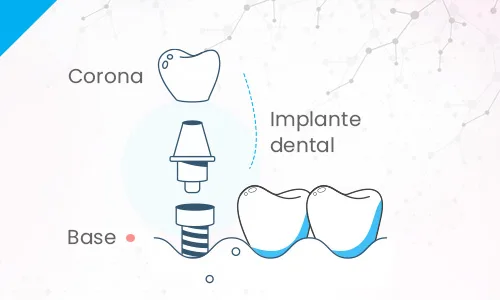 implante-dental