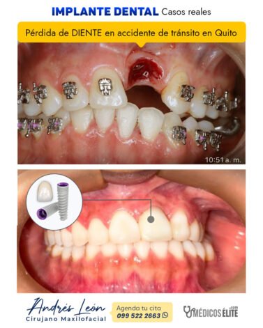 implante-dental-caso-real-accidente-quito