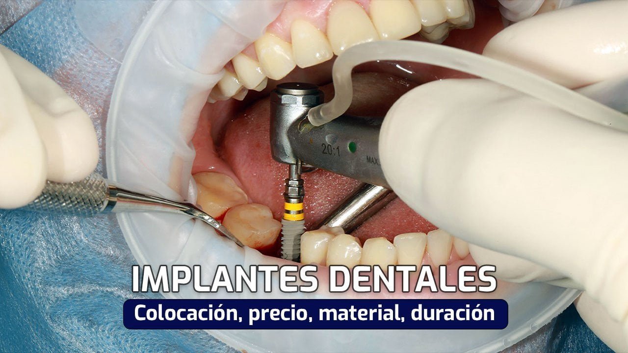 implantes dentales colocacion precio duracion