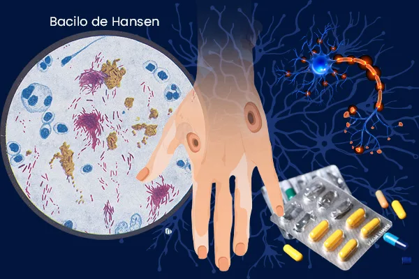 Lepra: Actualización médica 2026