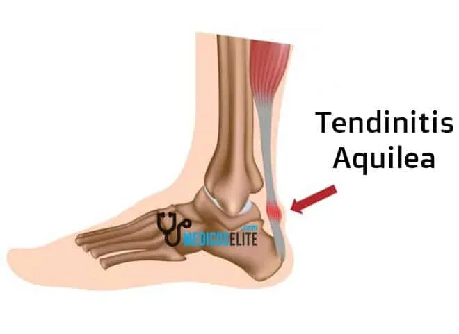 Lesiones deporte tendinitis aquilea