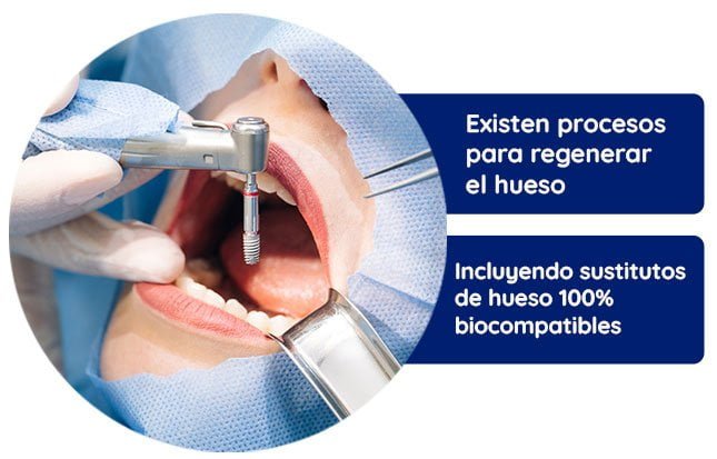 Existe regeneración ósea en el proceso de implantes dentales