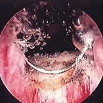 reseccion-trasuretral-de-prostata