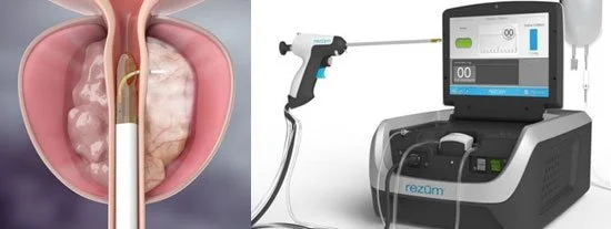 rezum-terapia-prostata-con-vapor-de-agua rezum-terapia-prostata-con-vapor-de-agua