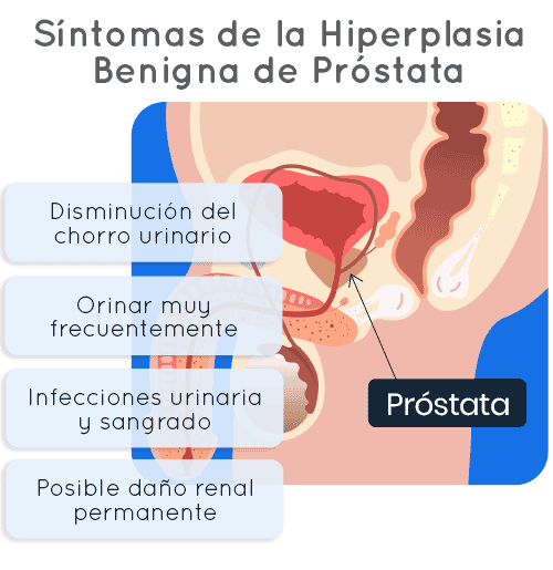 sintomas hiperplasia benigna de prostata