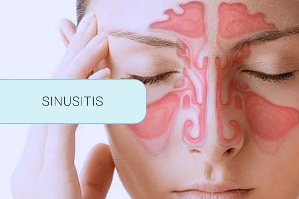 terapia-neural-sinusitis