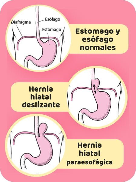 Tipos de hernia hiatal