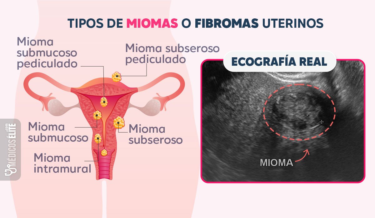 Tipos de miomas