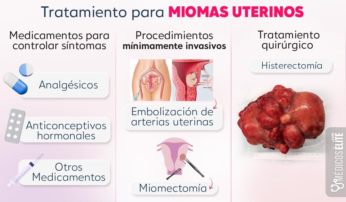 Tratamiento Para Miomas Uterinos Tratamiento Para Miomas Uterinos