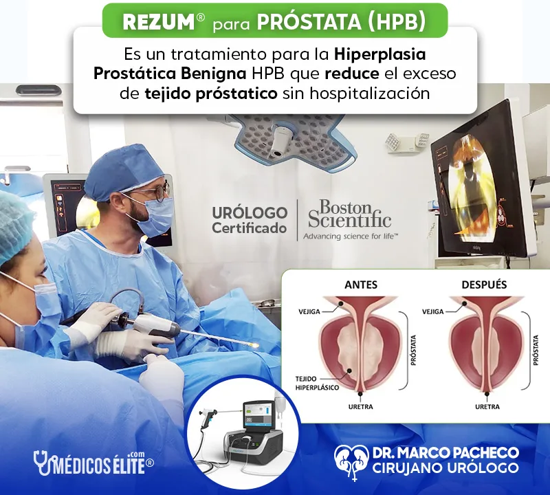 Rezum Quito - Tratamiento para Próstata HPB