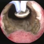 vaporizacion-de-plasma-prostata