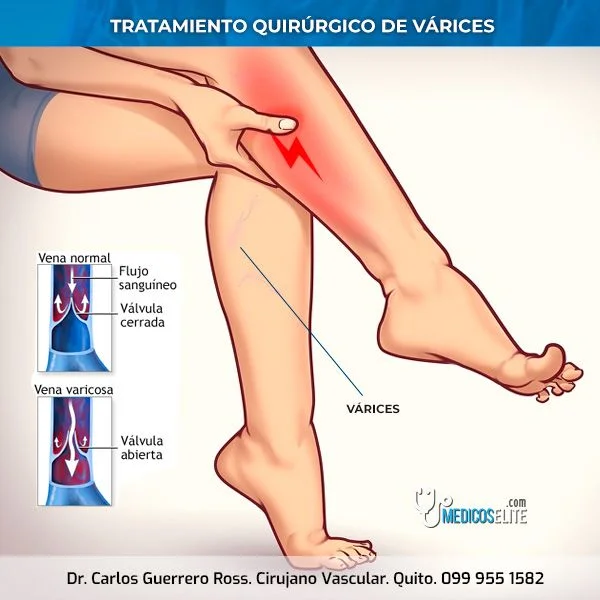 varices-tratamiento-quirurgico-quito