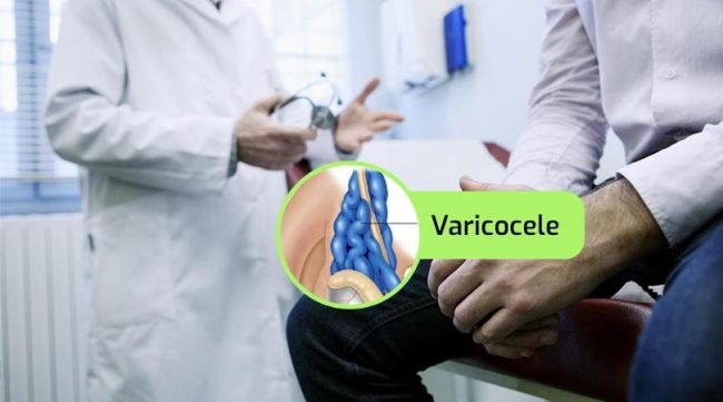 varicocele-urologia