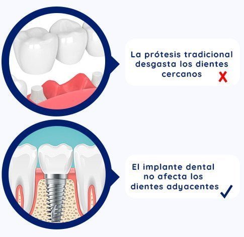 Los implantes dentales no desgastan los dientes cercanos